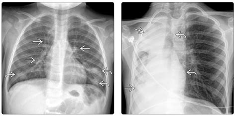 can chest xray show asthma|How to Be Diagnosed with Asthma: For Children and .